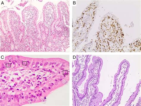 Case 1. A, Duodenal mucosa with mild villous atrophy (H&E Â100). B,... | Download Scientific Diagram