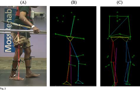 Figure 1 from Instrumented Gait Analysis: A Tool in the Treatment of ...