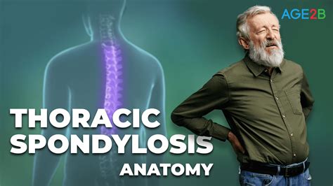 Thoracic Spondylosis | Anatomy - AGE2B