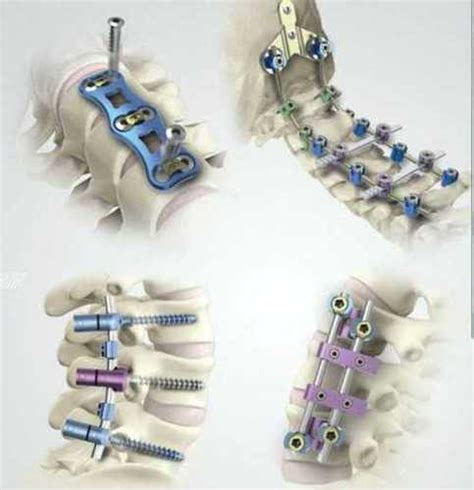 Platinum Titanium Spinal Implants For Surgery at 2500.00 INR in Delhi | Yadav Surgicals & Plastic