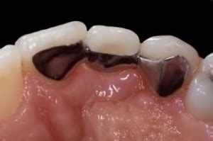 Dental Bridges Cost, Types & Procedure