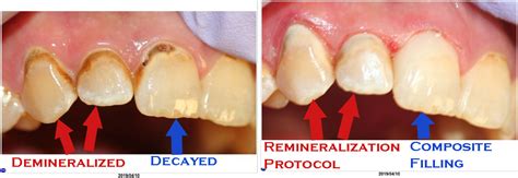 Remineralization is Real: reversing bracket scars and discolored roots ...