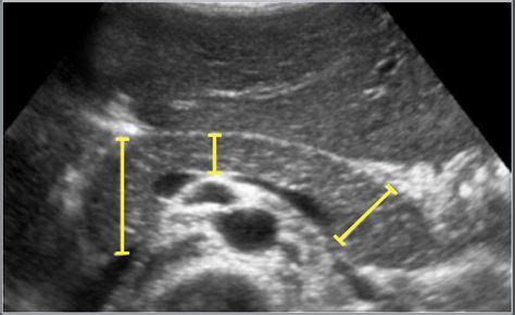 The Radiology Assistant : Normal Values - Ultrasound | Ultrasound, Normal values, Ultrasound ...