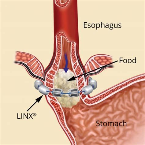 LINX System For Reflux Disease - Illinois Bariatric Center