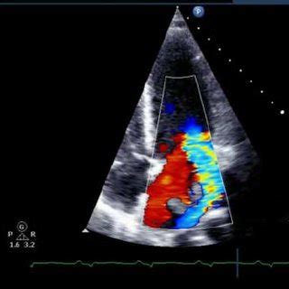 Apical four chamber view. Colour Doppler showing a single severe mitral... | Download Scientific ...