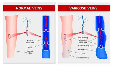 Apa Itu Varises Vena? Ketahui Penjelasannya Biar Tak Salah Penanganan | merdeka.com