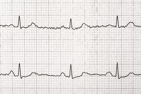 Normal Electrocardiogram Record — Stock Photo © radub85 #42281661