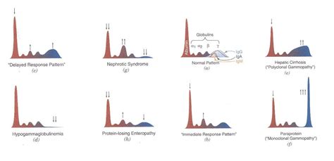 Interpreting serum protein electrophoresis (SPE) patterns – BCIT News