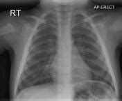 Chest radiograph (pediatric) | Radiology Reference Article | Radiopaedia.org