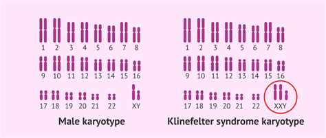 Normal karyotype and Klinefelter syndrome