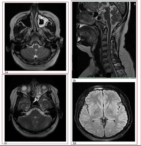 Axial section of T2 MRI brain at the level of the medulla (1a) and pons... | Download Scientific ...