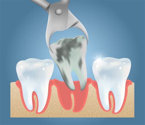 Tooth Extractions - Normandy/Lakewood Dentistry - Jacksonville, FL