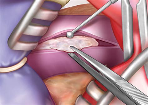 AUBMC performs the first-of-its-kind Pulmonary Endarterectomy surgery in Lebanon and the region ...