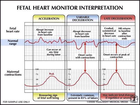 OB Fetal Heart Tone Monitoring Decelerations-Learn how to view, detect, and monitor fetal heart ...