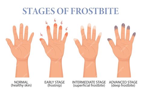 Premium Vector | Frostbite stages. frozen hands in different stages. medical frostbite.health ...