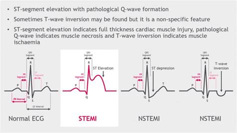 Diagnosis of STEMI