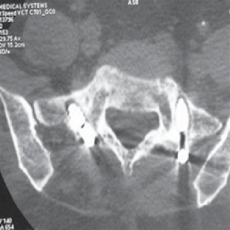 Patient 57 years. Ds: Degenerative scoliosis. X-rays before and after ...