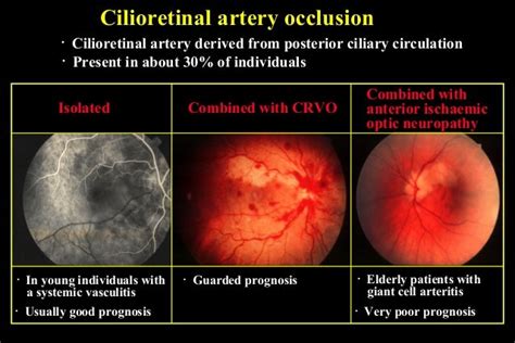 Retinal Vascular occlusion