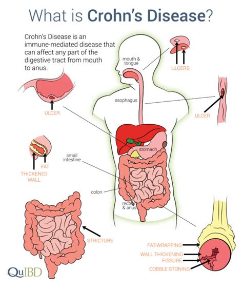 Crohn's Disease IBD Symptoms Advances Impact Causes