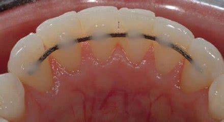 The importance of Retainers - Peninsula Orthodontics