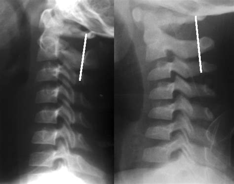 Hangman's fracture. Causes, symptoms, treatment Hangman's fracture