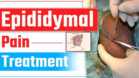 Varicocele or Epididymal Cyst | Epididymal Pain Treatment | Dr Health ...