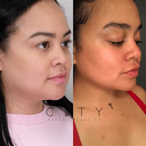 NYC Buccal Fat Removal Before and After Pictures | New York | UES