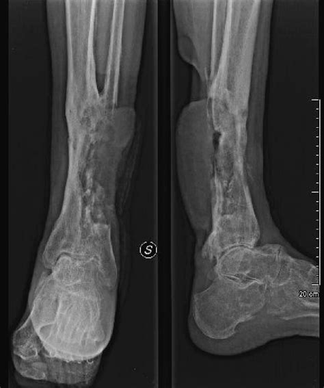 Aggressive, Metastatic Squamous Cell Carcinoma After a 46-Year-Old History of Chronic ...