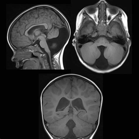 Dandy Walker Malformation | Pediatric Radiology Reference Article | Pediatric Imaging | @pedsimaging