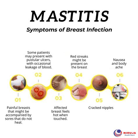 Mastitis: Symptoms of Breast Infection