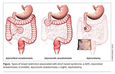 Intestinal failure – improving long-term survival | Medicine Today