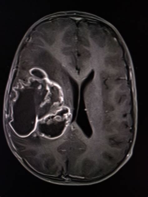 Supratentorial Ependymoma | Radiology, Mri