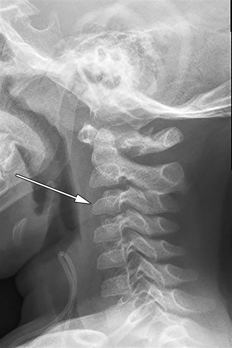 Emergent Imaging of Pediatric Cervical Spine Trauma | RadioGraphics