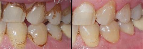 Scaling Root Planing Before And Stains