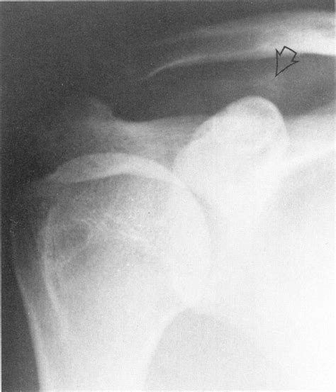 Calcification (arrow) has occurred in the region of the... | Download ...