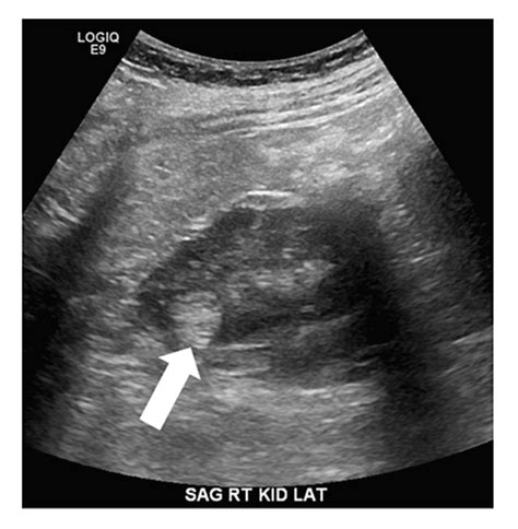 Angiomyolipoma Ultrasound