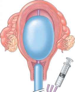 Bakri Balloon - Postpartum Hemorrhage - Mitch Medical Healthcare