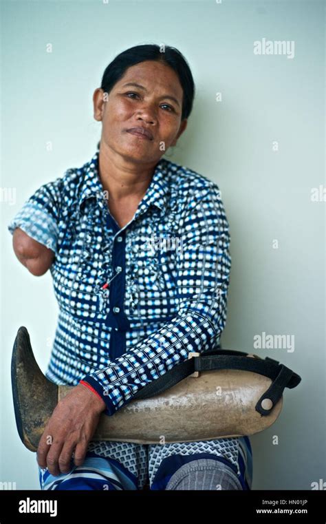 Model released portrait of a Cambodian land mine survivor, who lost an ...