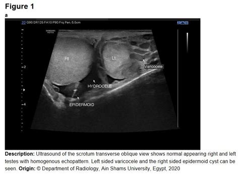 Ultrasound of the scrotum transverse oblique view shows normal ...