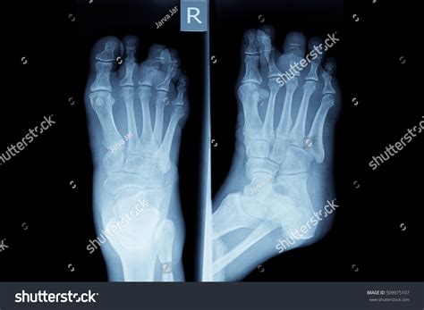 Xray Right Foot Show Closed Fracture Stock Photo 509975107 | Shutterstock