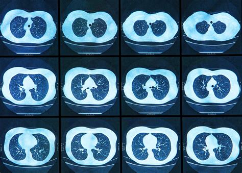 Common Features on Chest CT May Aid Diagnosis of COVID-19 - Medical Bag