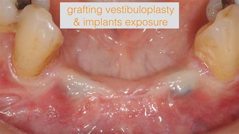 Online Course: Vestibuloplasty: Indications and Techniques for Enhancing Soft Tissue and Zone of ...