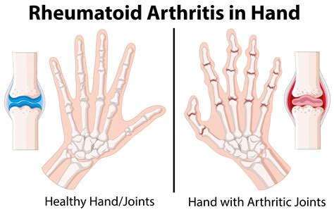 Diagram showing rheumatoid arthritis in hand 446937 Vector Art at Vecteezy