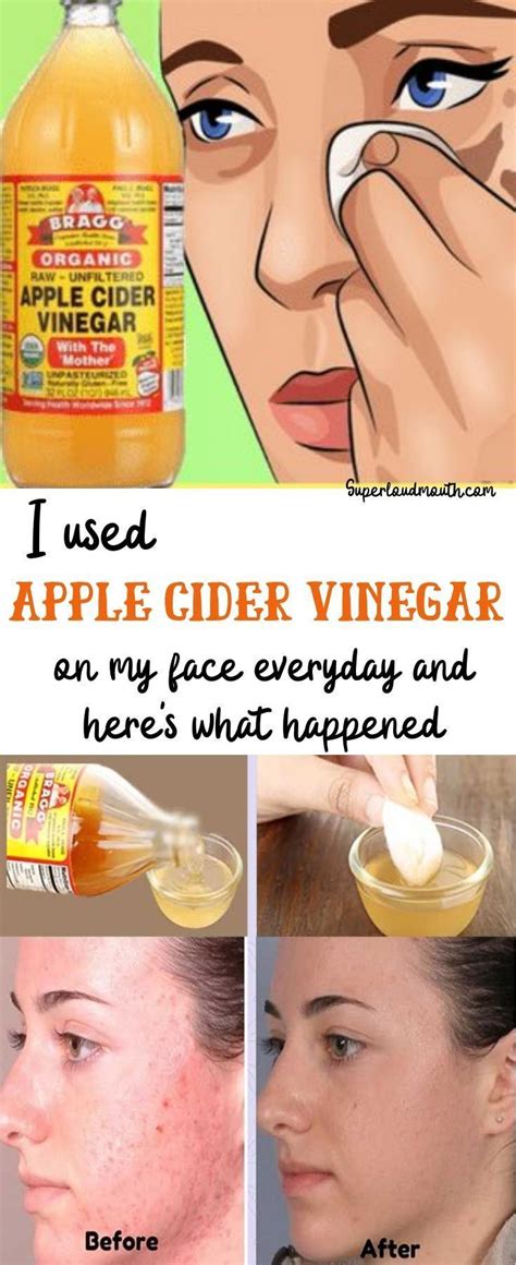 Apple Cider Vinegar For Skin, Apple Cider Vinegar Benefits, Apple Cider For Acne, Apple Cider ...