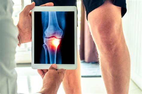 Knee Osteoarthritis: How (and Why) to Avoid Knee Replacement | Regenexx ...