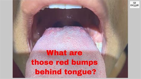 What Causes Red Bumps On Back Of Throat - Printable Templates Protal