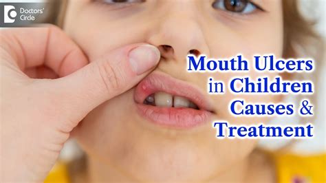 Mouth Ulcers in Children | MOUTH ULCER Treatment & Causes - Dr. K ...