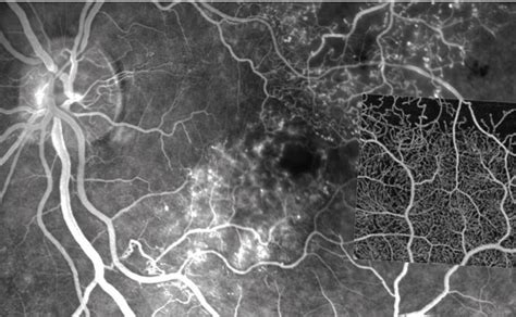 Noninvasive angiography with OCT offers definite value