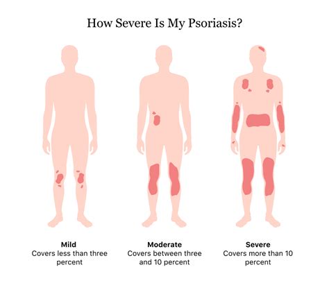 Psoriasis | Symptoms, Causes, Types and Treatments