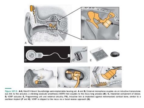 Middle ear implants